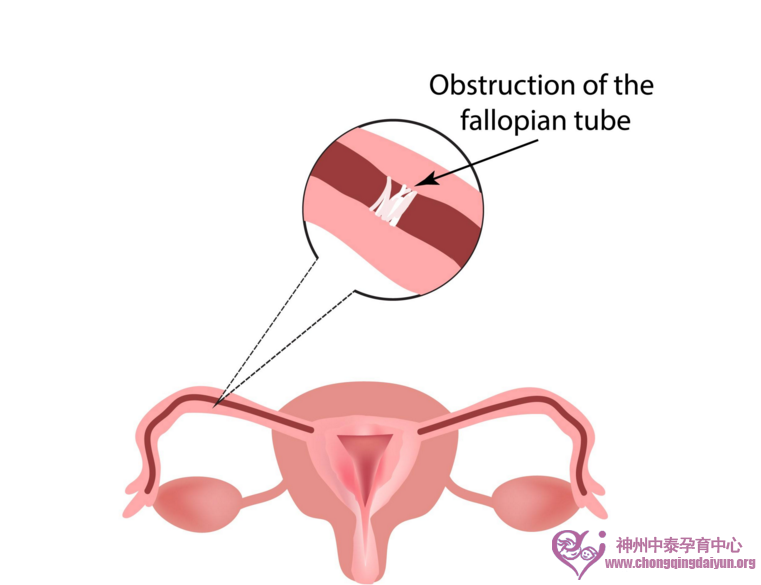 双侧输卵管堵塞最合适的方式是做试管婴儿！