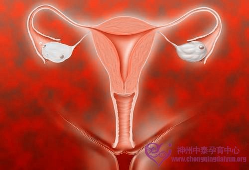 卵巢过度刺激综合症，美国试管婴儿过程可预防