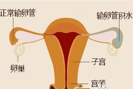 中国试管婴儿输卵管积水怎么办？